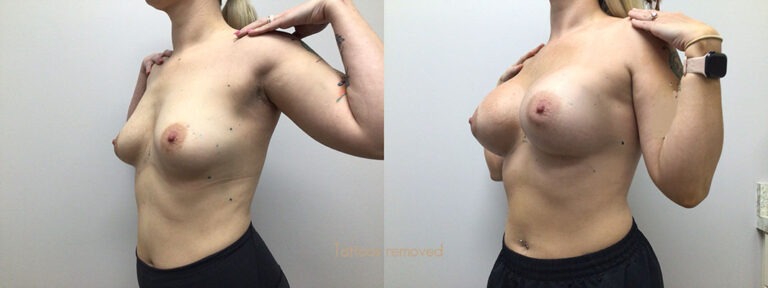 Breast Augmentation Surgery