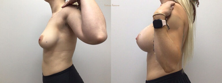 Breast Augmentation Surgery