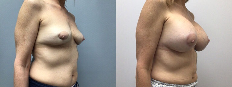 Breast Augmentation Surgery