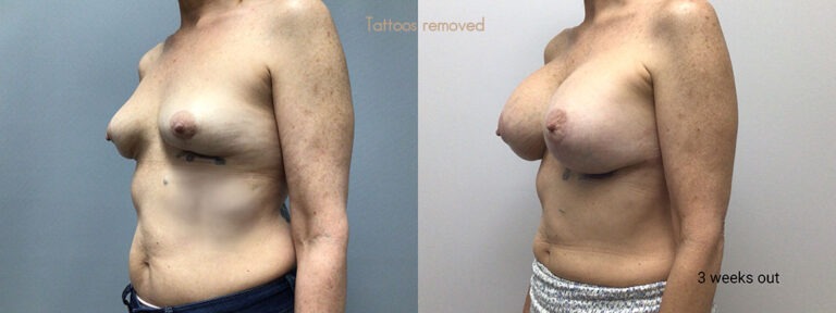 Breast Augmentation Surgery