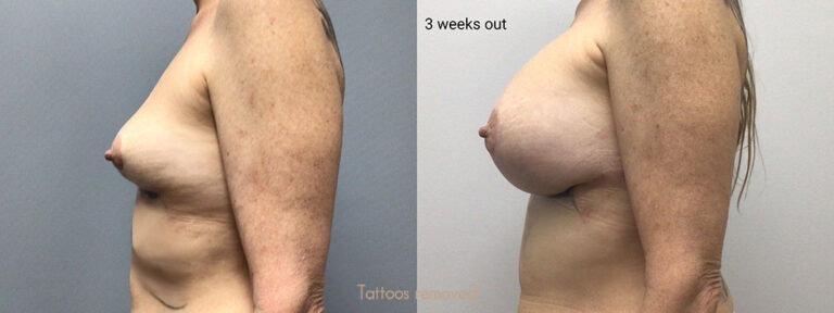 Breast Augmentation Surgery