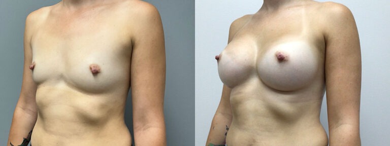 Breast Augmentation Surgery