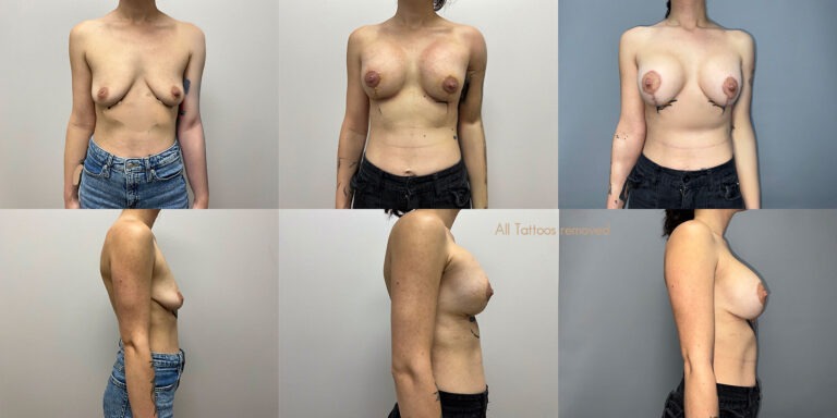 Breast Augmentation Surgery