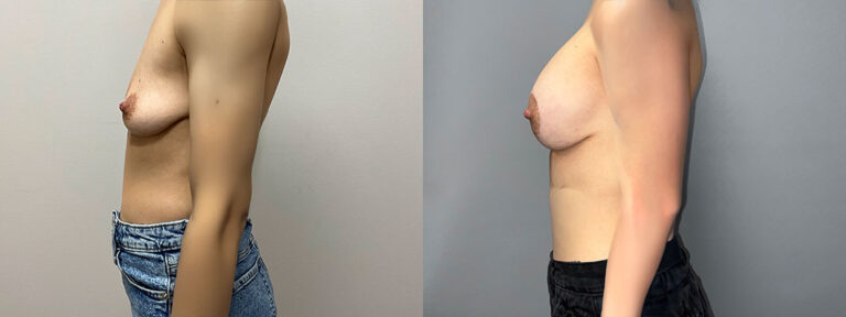 Breast Augmentation Surgery