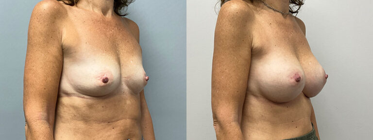 Breast Augmentation Surgery