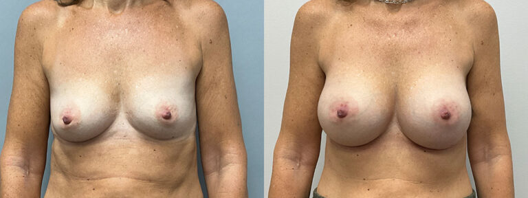 Breast Augmentation Surgery