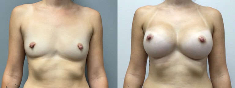 Breast Augmentation Surgery