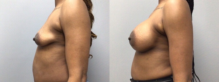 Breast Augmentation Surgery