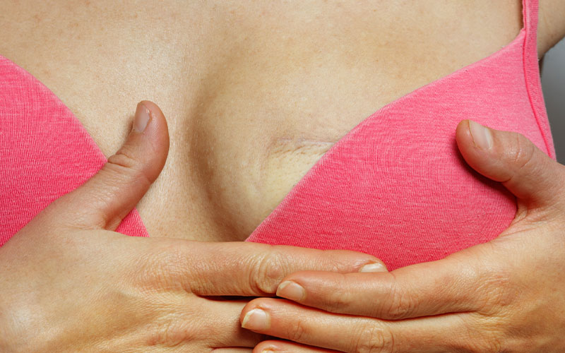 Breast Reconstruction